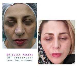 جراحی زیبایی بینی گوشتی