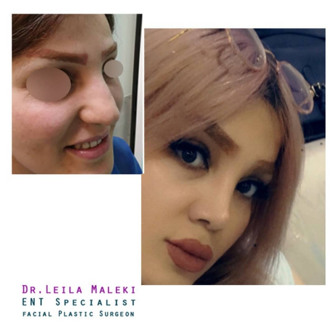 نمونه جراحی بینی دکتر لیلا ملکی