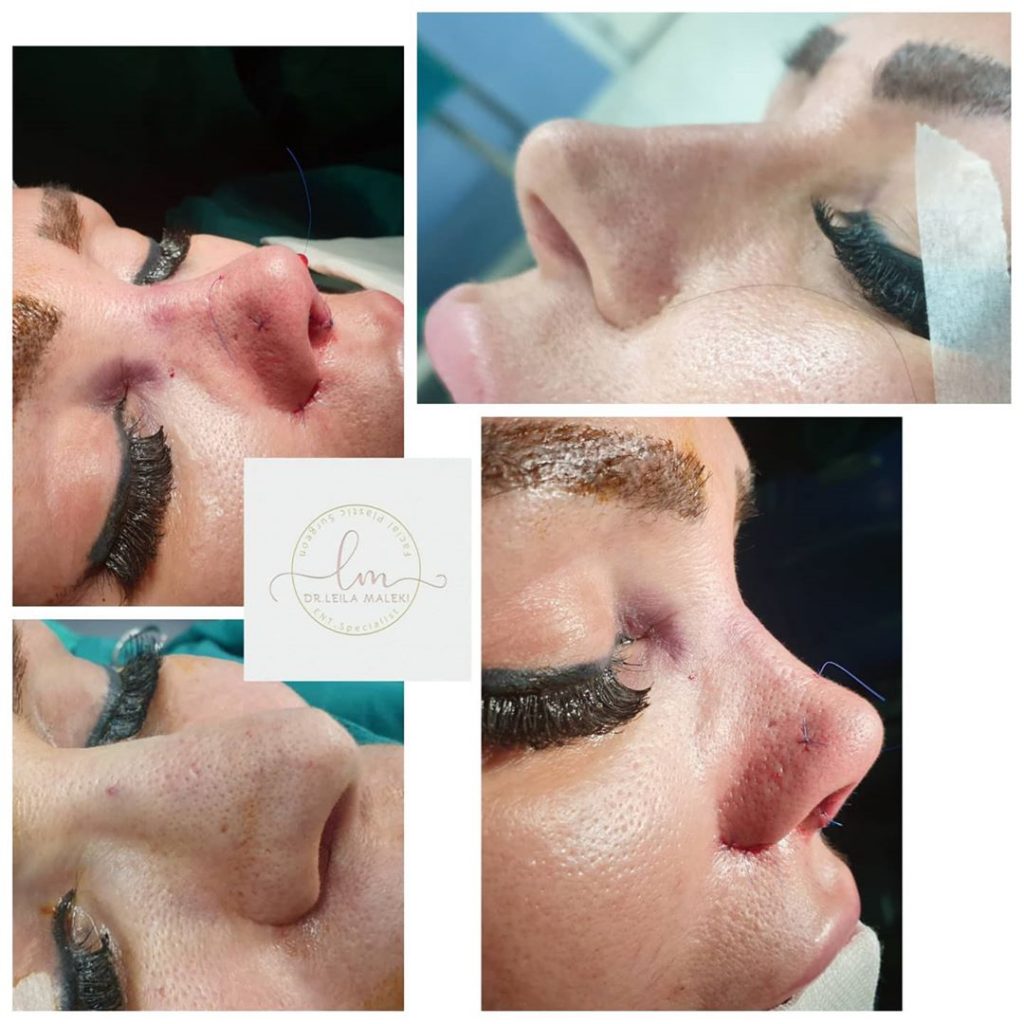 جراحی بینی ترمیمی دکتر ملکی
