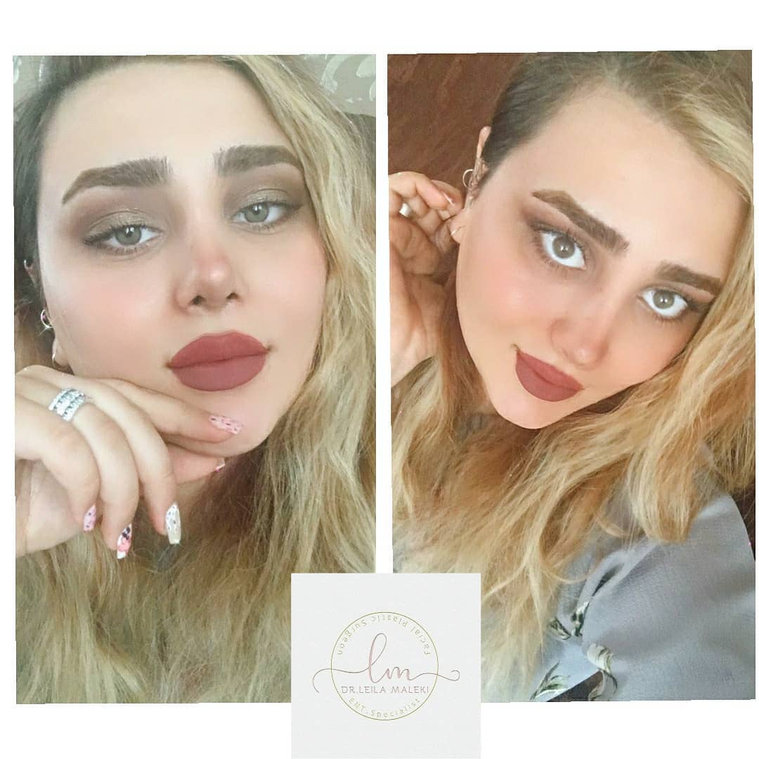 نمونه جراحی بینی دکتر لیلا ملکی