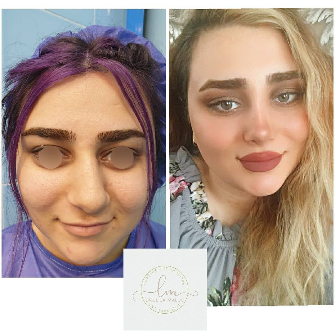 نمونه جراحی بینی دکتر لیلا ملکی