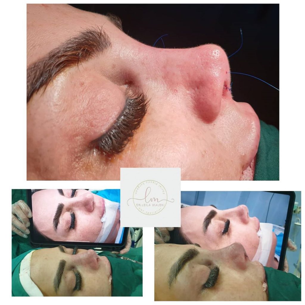 عمل ترمیمی بینی