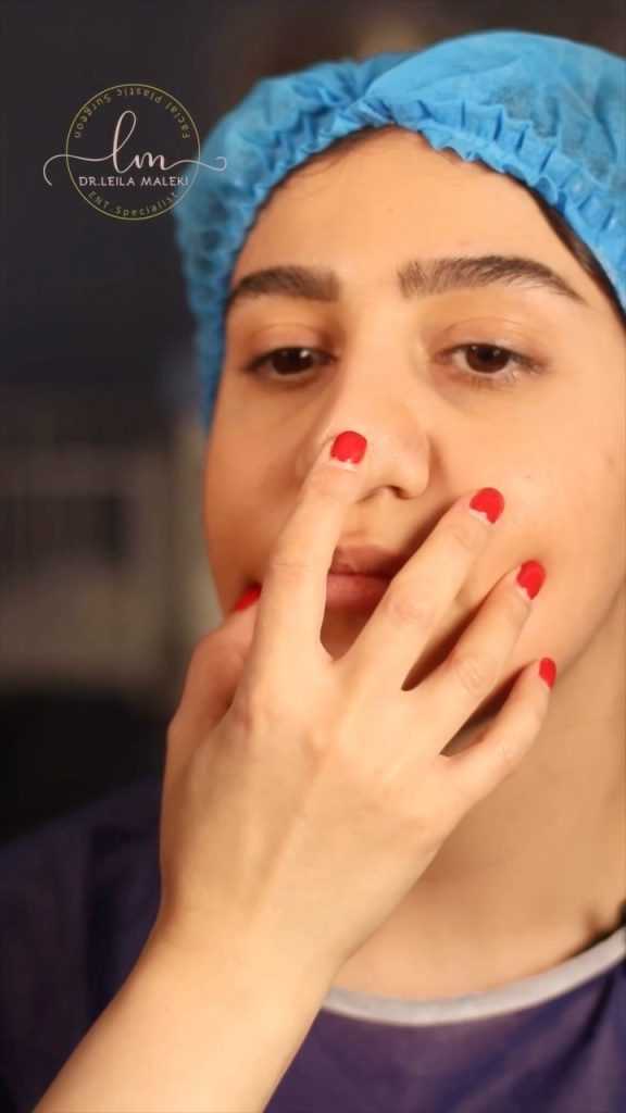 جراحی بینی باز یا بسته کدام روش برای شما مناسب‌تر است؟