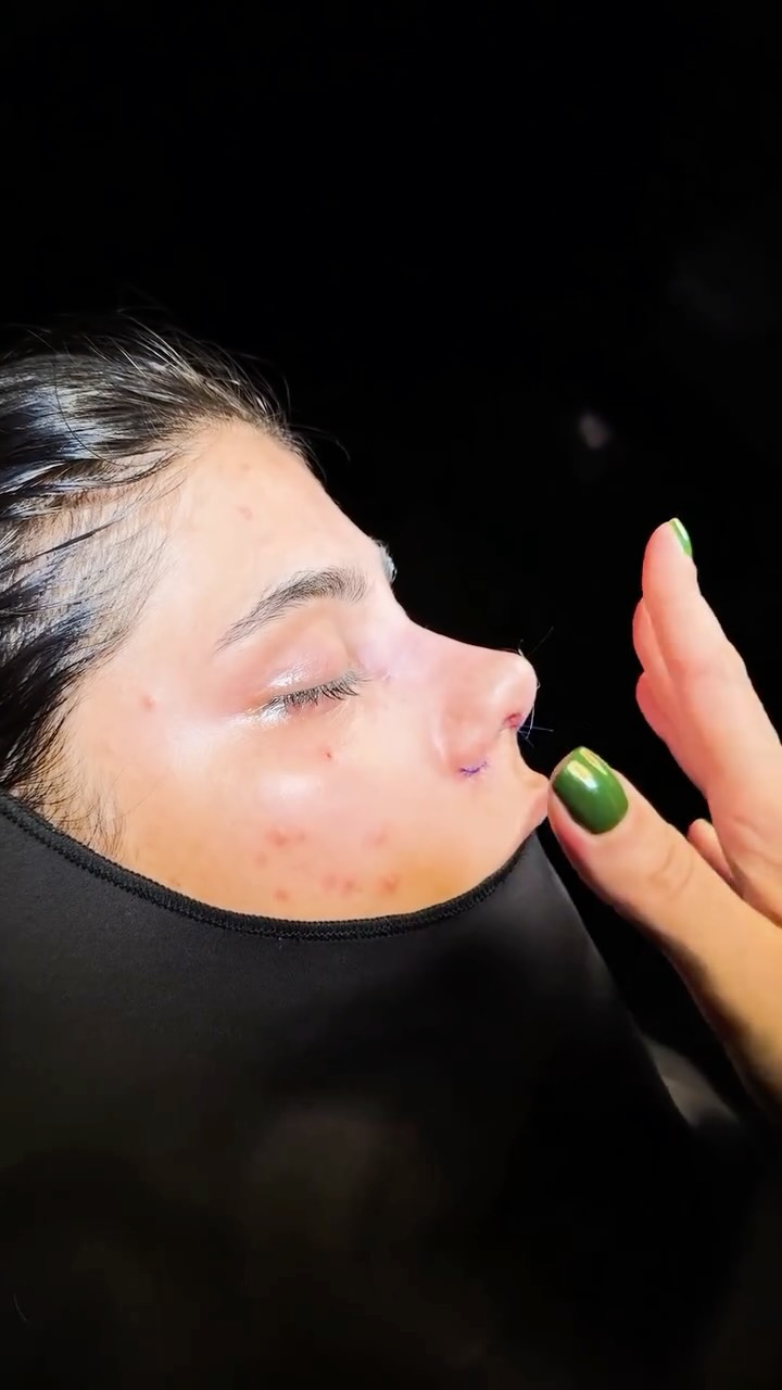 👃 نکات کلیدی برای نتیجه طبیعی و ماندگار در جراحی بینی