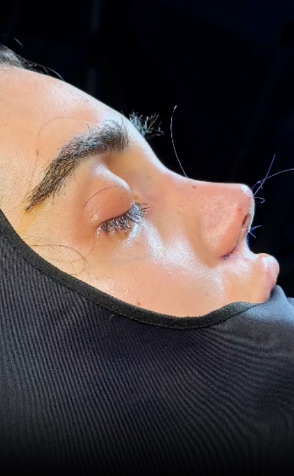 اگر از فرم بینی خود ناراضی هستید، این نکات را بدانید 👃✨