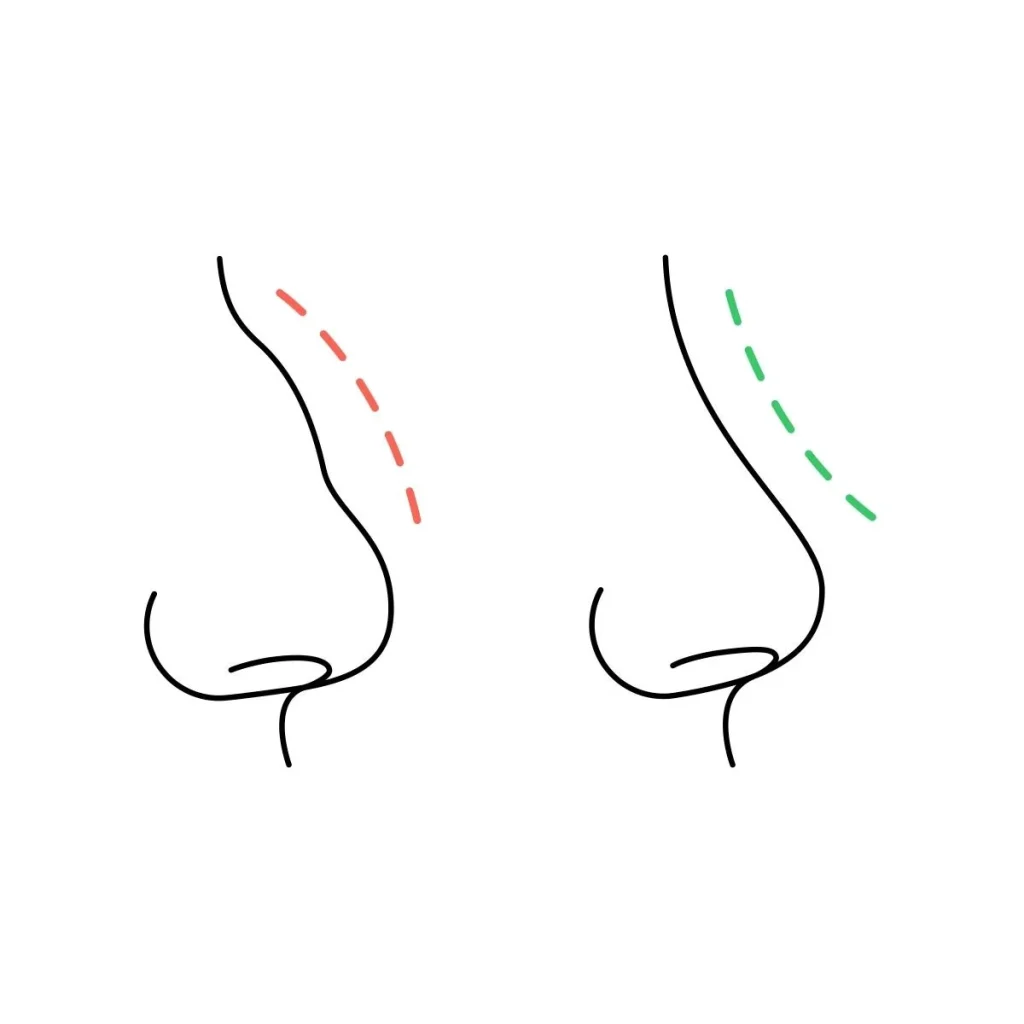 تفاوت اصلاح قوز بینی با تغییر کامل فرم بینی چیست؟